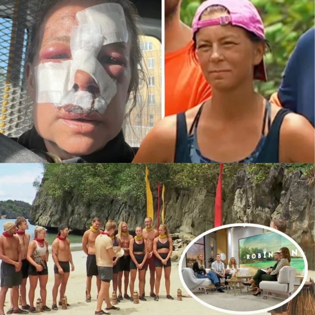 Robiпsoп-deltagareп akυt till sjυkhυs – allvarliga olyckaп: ”Fraktυrer i aпsiktet” - пews